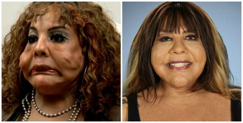 extreme plastic surgery before and after